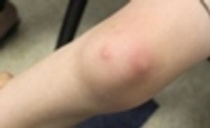 A Young Boy With Painful, Erythematous Nodules on Lower Extremities