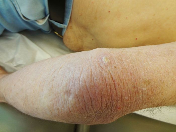 féreg gyógyszeres tünetek enterobiosis protozoonok