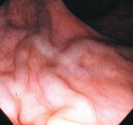 varicoza în anus
