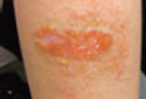 Neomycin Contact Dermatitis