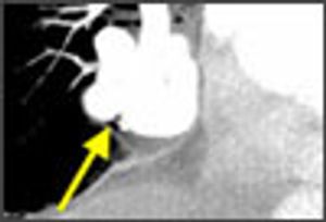 Pulmonary Arteriovenous Malformation in a Woman With Severe Mitral Valve Stenosis