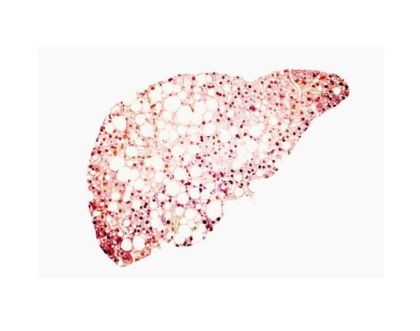 Hepatic Steatosis is a Risk Factor for MACE, Even 