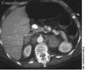 Bilateral Adrenal Hemorrhage in a 48-Year-Old Woman