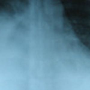 Ovarian Hyperstimulation Syndrome