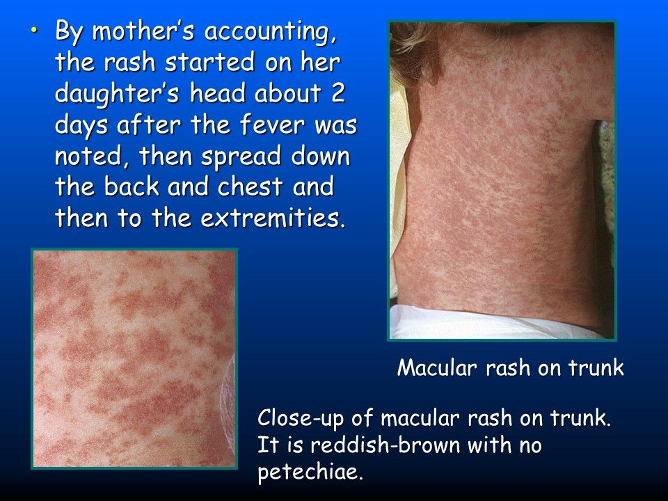 A Very Sick 3-Year-Old: Fever, Cough, Congestion & Rash