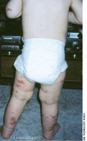 Toddler With Henoch-Schönlein Purpura