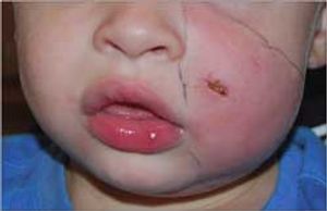 Dog Bite in a 2-Year-Old Boy