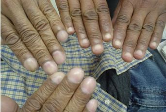 Fingernail Clubbing A Sign Of Lung Cancer