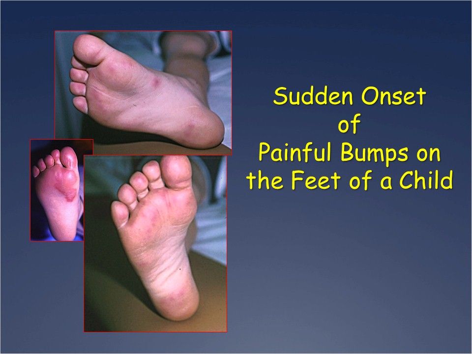 Sudden, Painful Bumps on the Feet of a 
