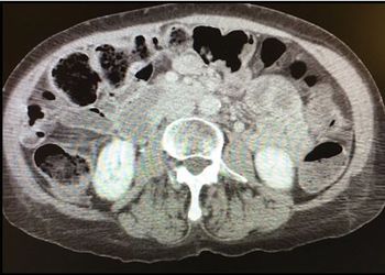 Chronic pancreatitis