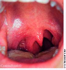 Deviated Uvula | Patient Care Online