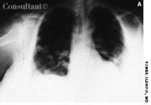 Asymptomatic 'Cannonballs' in the Lungs