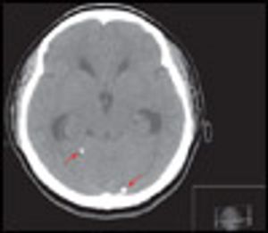 Neurocysticercosis