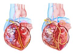 Apixaban May be the Safer DOAC in Afib, Suggests First Large Comparative Analysis 