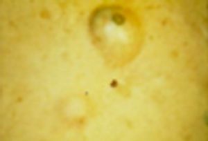 Epidermoid Cysts Treated With Phosphatidylcholine Injections