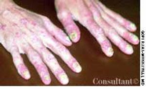 Psoriatic Arthritis in Hands and Fingers of a 38-Year-Old Woman