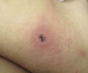 Image IQ: Rash with Chills, Neck Pain, Acute Fever