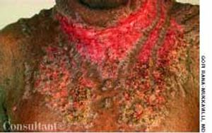 Contact Dermatitis to Copper