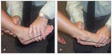 Talar Tilt Test