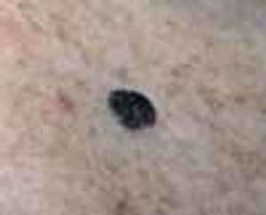 Seborrheic Keratoses