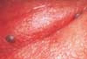 Acquired Angioedema