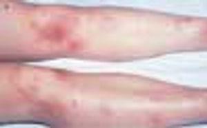 African American Woman With Bilateral Ankle Pain and Nodular Rash on Shins: Hepatitis? Strep Infection? Gonorrhea? Sarcoidosis?