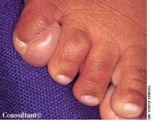 Infantile Digital Fibromas