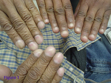 Chronic Shoulder Pain And Fingernail Clubbing In A Middle Aged Man