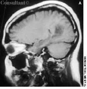 Astrocytoma in Pregnancy