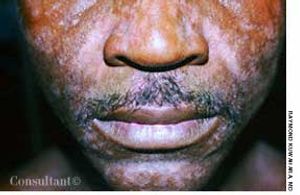 Seborrheic Dermatitis and HIV