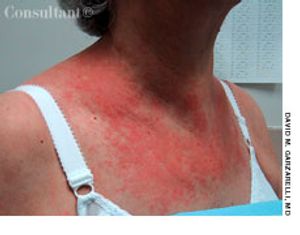 Cutaneous T-Cell Lymphoma in a 78-Year-Old Woman