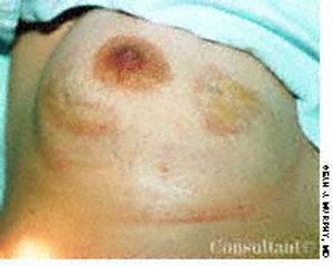 Morphea