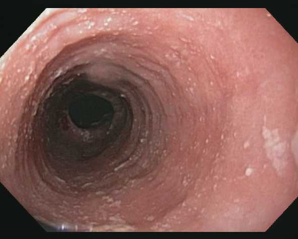  Eosinophilic Esophagitis  Which Rx When and for How Long 