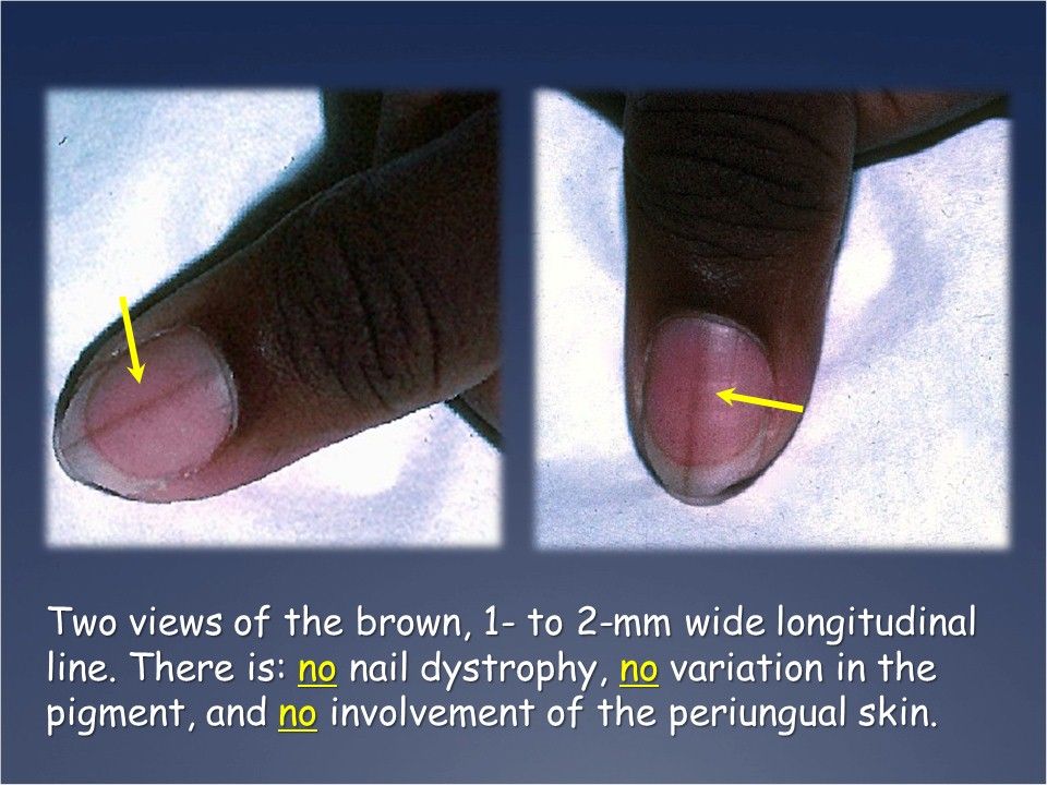 a-long-brown-line-under-a-young-woman-s-fingernail