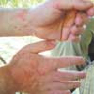 Jellyfish Sting