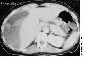 Subcapsular Hematoma of Liver