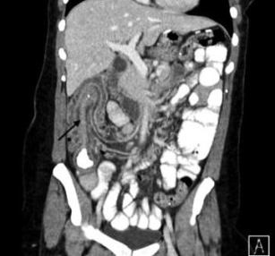 Adult Intussusception: A Rare Cause of Bowel Obstruction | Patient Care  Online