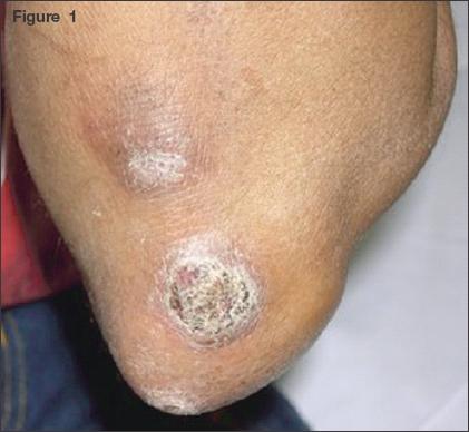 Hansen Disease (Leprosy)