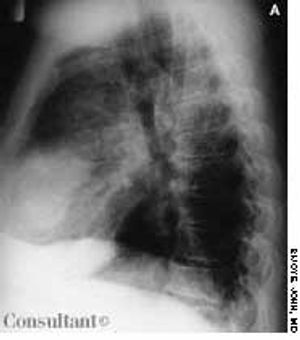 Pseudotumor