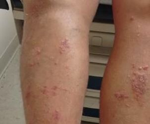 Papiular Rash Legs Pruritic Papulovesicular Rash on Lower Legs: Your Dx?
