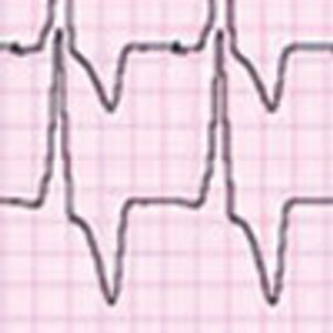 Right Bundle-Branch Block After Pacemaker Implantation