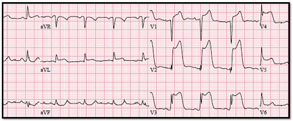 Serial EKGs, STEMI, ACS, acute coronary syndrome