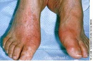 Acute Gouty Arthritis in a 56-Year-Old Man