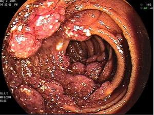 A Rare Finding of Lymphangiomatosis: Case Report 