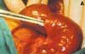 Inhaled Corticosteroids Lower Death Risk in COPD