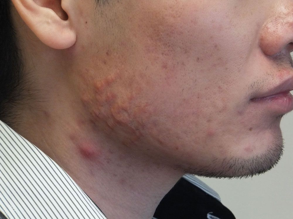 Comedonal Inflammatory Acne