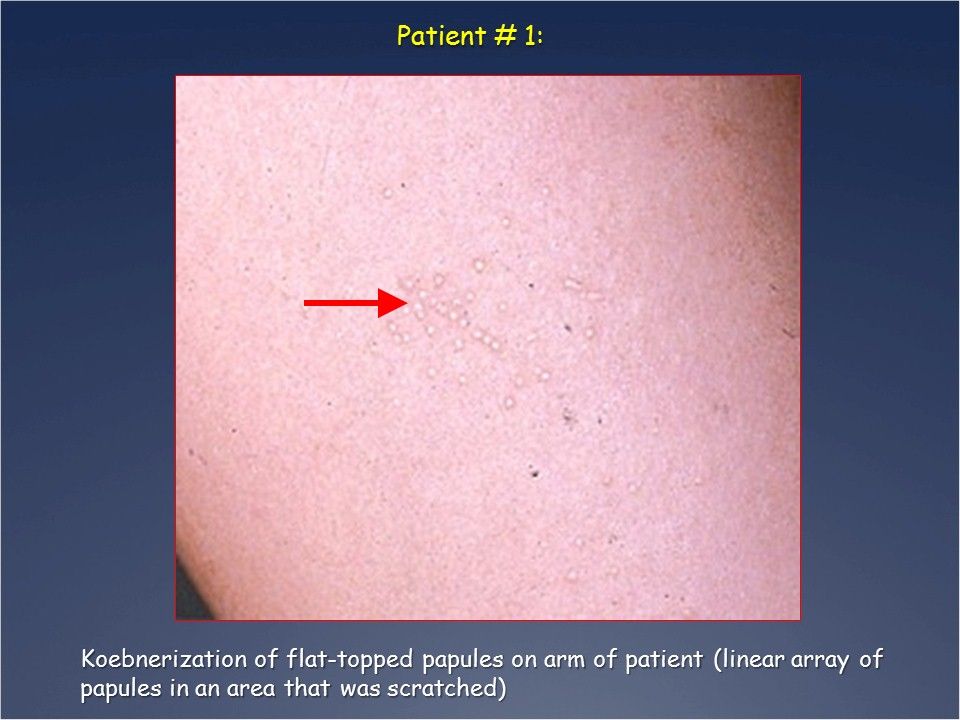 Lichenoid Eruptions: Can You Match that Rash with the Dx?