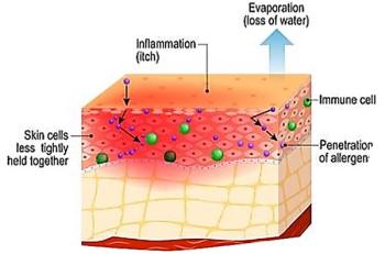 Atopic Dermatitis: The Pipeline and Clinical Approaches That Could Transform the Standard of Care / image credit ©designua/stock.adobe.com
