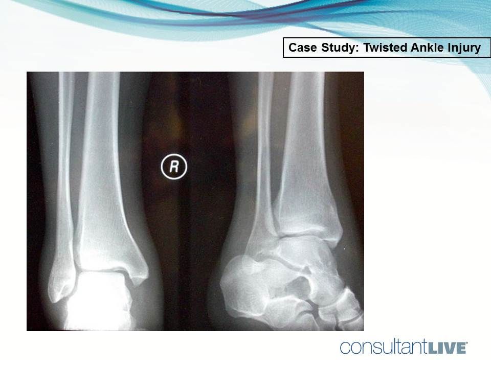 Maisonneuve injury of the ankle 