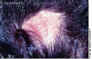 Pressure Alopecia